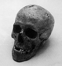 Merovingsche schedel met genezen slagwonde (Rosmeer 6de eeuw)